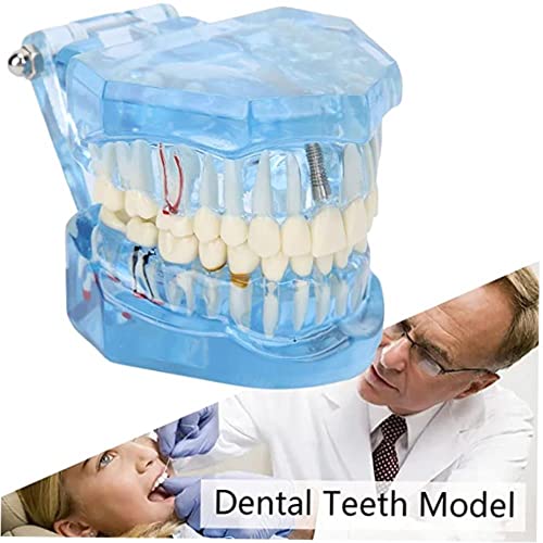 Анатомическая модел на зъби - Прозрачна Демонстрация и Симулация модел на зъбите за обучение на устната кухина, наръчник за зъбите и Венците - Акрилна Синя Видима А?