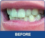 10 Спринцовка от 3 ml За Избелване на Зъбите 44% Карбамидный Гел За Избелване на Зъбите Bleach Professional Стоматологичен