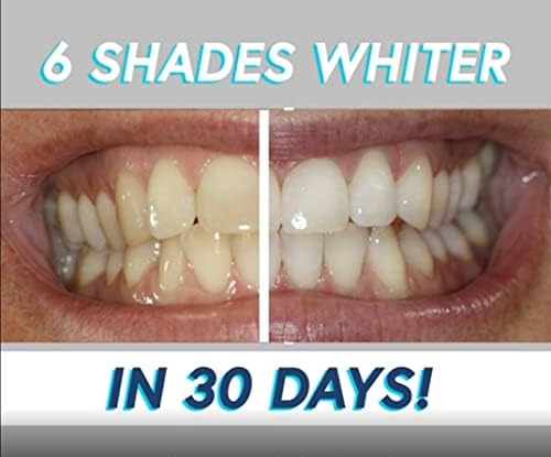 Писалка за избелване на зъбите Smileactives Advanced - с Избелващ гел за бели зъби, писалка за избелване на зъбите