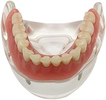 KH66ZKY ГРИЖИ за Начинаещи модел за изучаване на зъби - Образователна модел за стоматолози - с 2 импланти Overdenture-Нисък