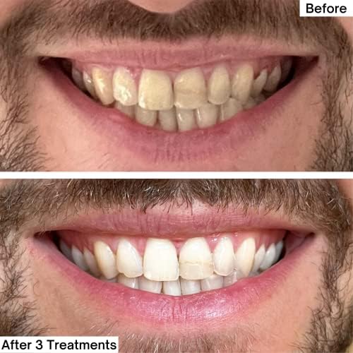 Прах за избелване на зъбите MySweetSmile - доставка белина в продължение на 6 месеца | Средство за отстраняване